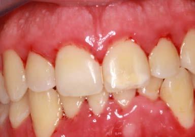 Zer ezagutuko du pazienteak? Zer da gaixotasun periodontala? Zer da bakterio-plaka (BP)? Bakterio-plakaren (BP) eta gaixotasun periodontalaren arteko erlazioa.