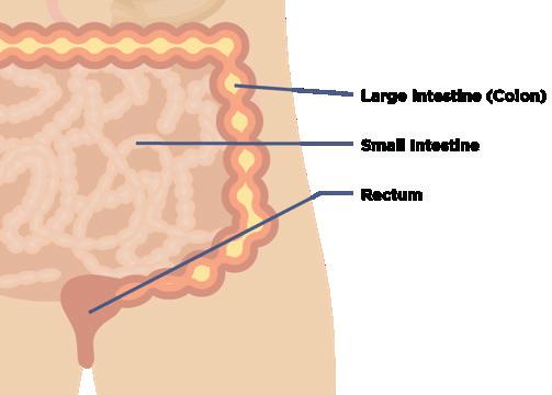 CAUSES OF ULCERATIVE COLITIS We don t yet know the cause of this condition although most doctors now think it relates to how patients react to the apparently harmless friendly bacteria that everyone