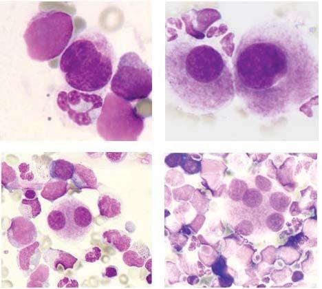Monolobated megakaryocytes Auer rods 3 Pseudo Pelger Hüet anomaly Abnormal