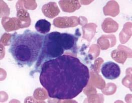CD34 Hemodilute smears Hypocellular MDS/ hypoplastic AML/ Aplastic anemia Multifocal accumulation of precursors Angiogenesis 2.