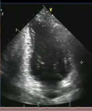 ECHO treatment: Regions of interest Y 3 Y 3 X 3 X 3 Locate the first sub-segment on the ultrasound image Determine its position as X 3 Y 3