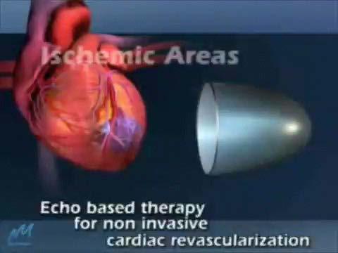 ESMR Therapy Extracorporeal Shockwave Myocardial Revascularization Shockwaves are special acoustic waves that can be focused on a selected area inside the body.