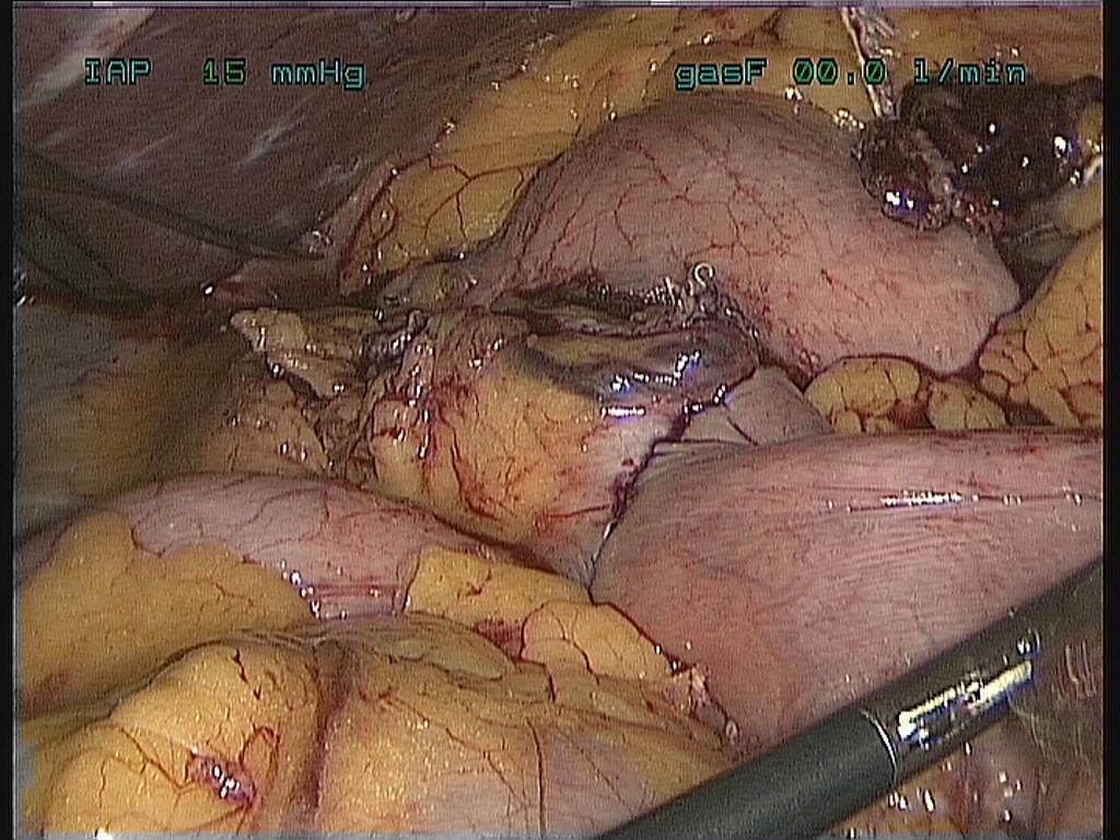 Operative technique / RYGB A small gastric pouch (20 40 ml) Biliopancreatic limb 50 80