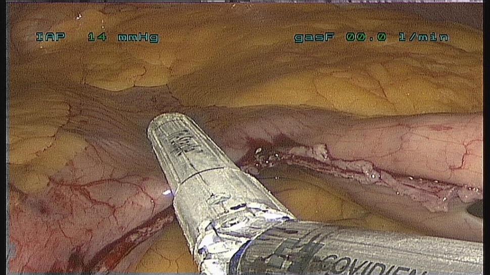 Long-term PROS for sleeve gastrectomy NO internal hernias NO bowel