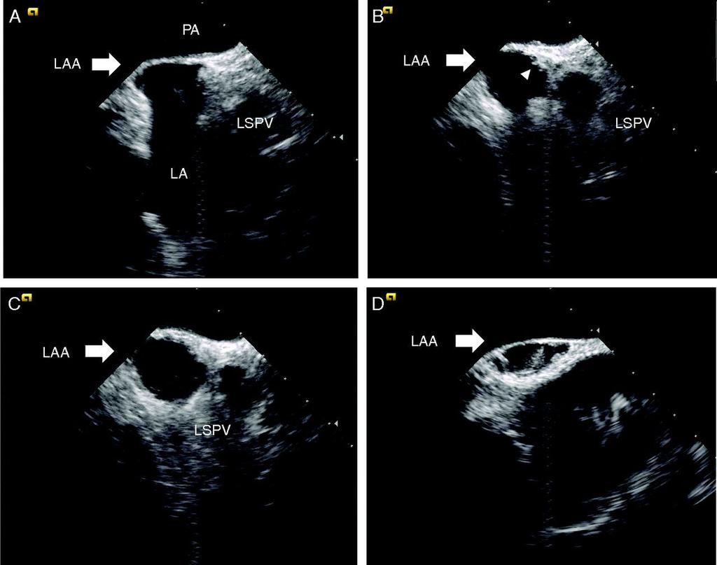 atrial appendage (A) Long-axis view of LAA and orifice. LSPV also observed.