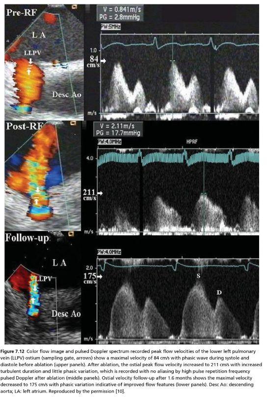 Hemodynamic changes during ablation Increased flow velocity following ablation.