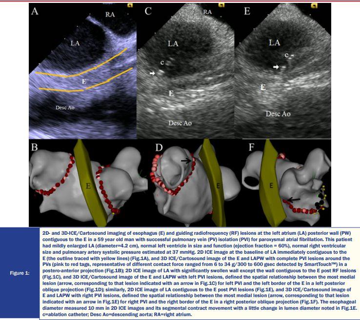 Esophageal Mapping To prevent esophageal injury, including perforation and atrioesophageal fistula Mostly achieved with esophageal temperature monitoring.