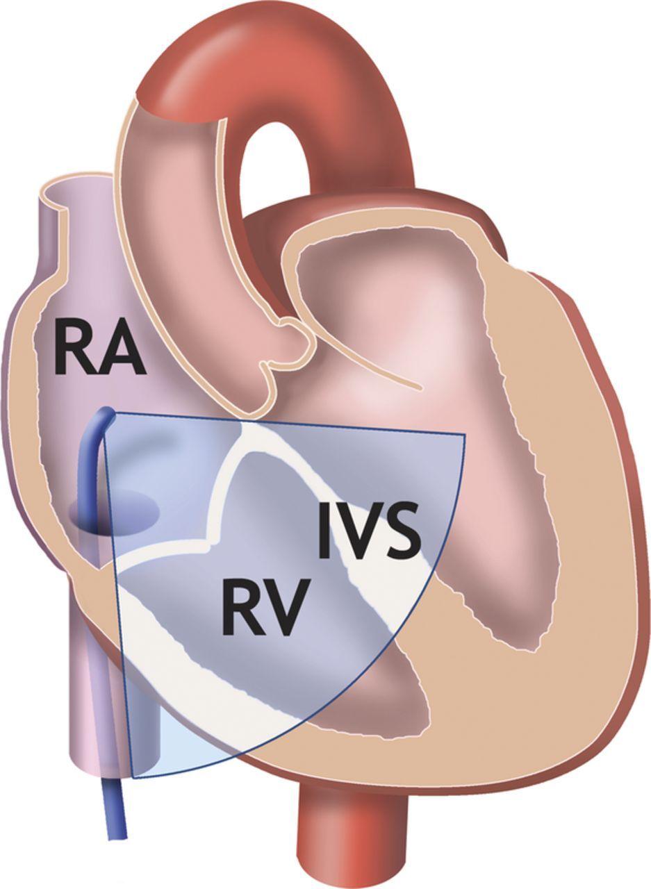 Home View Home view showing the right heart, including the interventricular septum: the slightly anteflexed