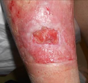 When his lower leg ulcer failed to improve despite adequate compression therapy (30 40 mmhg) and standard wound care, HCN referred patient to the Complex Wound Care and