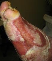 Case 11 Patient with Left Foot DFU that Failed to Heal Post Skin Graft This 66-year patient was referred to the Complex Wound Clinic by the HCN in December 2014 for left foot ulcer that failed to