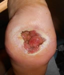 Case 12 Patient with Left midfoot plantar DFU with 4 th & 5 th Toe Amputations and Charcot Deformity This 55-year patient was referred to the Complex Wound Clinic by HCN in June 2016 for his