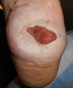 The patient already had his left 4 th and 5 th toes amputated because of previous infected DFU. He really wanted to heal this plantar DFU as he did not want to have his foot amputated.