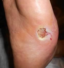 Case 13 Patient with Recurrent Right Foot DFU on Midfoot Medial Side This 78-year patient was referred to the Complex Wound Clinic by the patient s Podiatrist in June 2016 for a nonhealing right foot