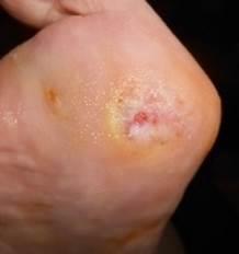 The patient stated that she developed theses 2 wounds in February 2015 because her right foot became deformed after right 2 nd, 3 rd and 4 th toes amputation in November 2013.
