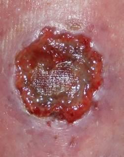 The patient was referred to the Complex Wound Clinic by HCN in December 2014 for a chronic nonhealing right lower leg ulcer. She has been treated by HCN since June 1, 2014.