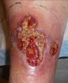 Case 5 Patient with Lower Leg Ulcer Likely Pyoderma Gangrenosum (PG) This patient was a 58-year old woman with a history of Lupus.