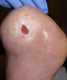 The PI started treating the patient with weekly sharp wound debridement and bacterial binding in addition to application of TCC Poor Man (adhesive felt with a horse-shoe hole underneath the DFU) for