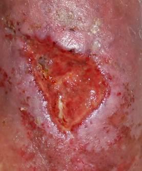 Case 8 Recurrent Left Lower Leg Ulcer for more than 70 years since age of 9 This 80-year patient has this recurrent left lower leg ulcer for more than 70 years since age of 9 after a traumatic injury.