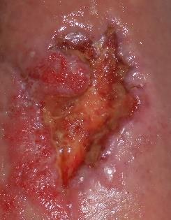 very slowly. Wound healing progressed slowly despite continuation of standard lower leg ulcer treatment including regular sharp wound debridement and weekly bacterial binding.
