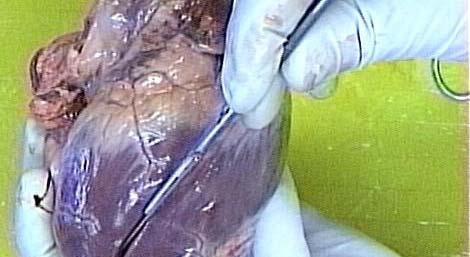 The first incision is along the right ventricle.