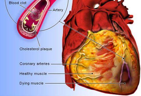 Heart Disease How does obesity lead to heart disease?