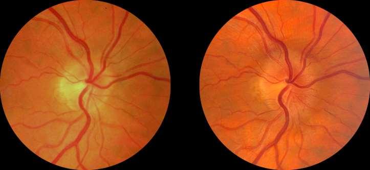 SANS case definition Diagnosis currently based solely on: Optic disc