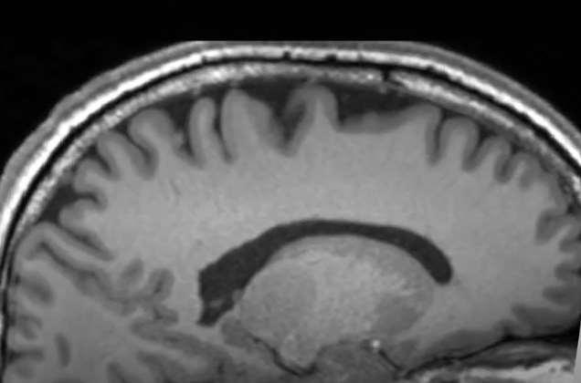 IIH SANS Source: ONH/Disc Roberts DR, Edema et al. Effects of Spaceflight on YES Astronaut Brain YES Structure Intracranial as Indicated Pressure on MRI. N Engl J Med 2017 Increased 377:1746-53.