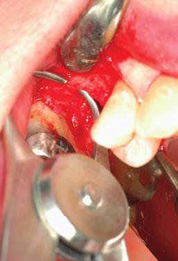 A reentry procedure was performed 16 weeks after implant placement, enabling the operator to record the same measurement as at the time of implant placement.