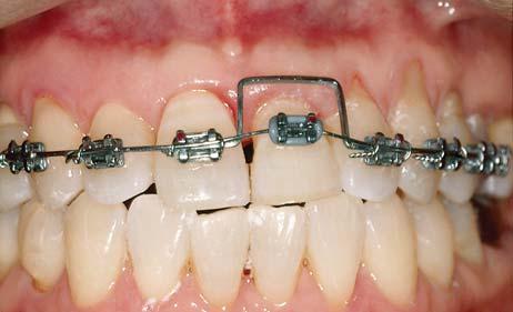 The restorative treatment plan for the extracted left central incisor was single implant therapy. Before extracting the tooth, consideration was given to the size of the resultant defect.