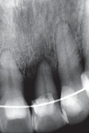 During the forced eruption procedure, the incisor edge was selectively ground to prevent premature contact. The characteristic red patch around the cervical gingival margin developed (Fig 3).