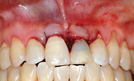 Fig 6a (Above) After suturing, the prepared temporary resin restoration was placed, and the incisal portion was completed by adding light-curing resin to prevent soft tissue irritation caused by