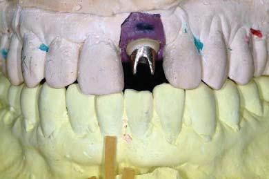 Fig 7 Customized esthetic abutment fabrication and final result.