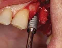 5 mm Hahn Tapered Implant was placed in the maxillary second bicuspid site.