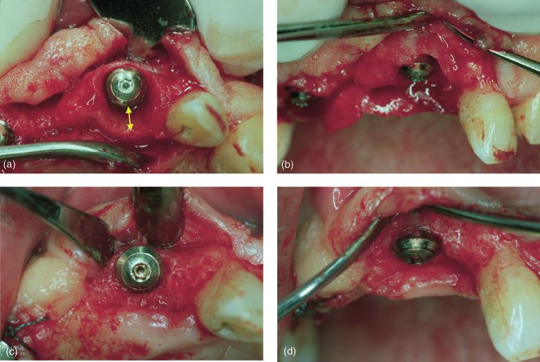 824 Botticelli et al. Fig. 4. Case E. M. C.: The implant was installed in the extraction socket in position 21 ((a) occlusal view; (b) buccal view). Note the wide palatal defect (arrow).