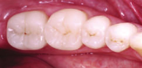 6b: Onlays on teeth 34 to 37 in the summer of 2015, after having been in situ for eleven years (cf. Fig.