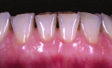 7c: Mandibular veneers in the summer of 2015: a severe wear facet has formed on tooth 43 over the eleven years since the veneers were placed (cf. Fig. 8b).