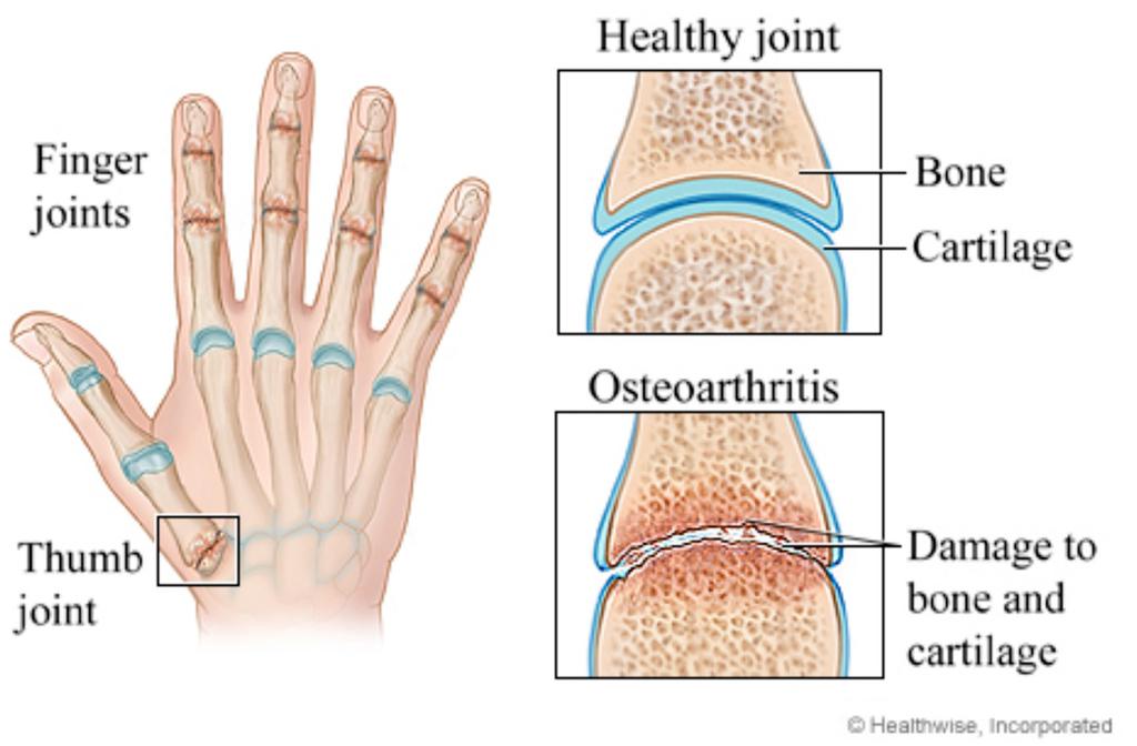 What is Osteoarthritis (OA)? Arthritis means inflammation in the joints. Osteoarthritis is the most common form of arthritis in the UK affecting up to 8.5 million people.