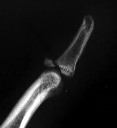 Mallet finger Avulsion distal extensor tendon Bony vs soft tissue Acute vs
