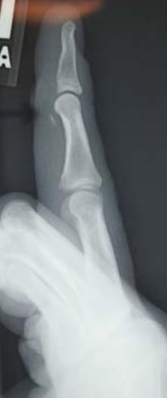 Jersey Finger Rupture of FDP Bony vs soft tissue Acute vs chronic Forceful