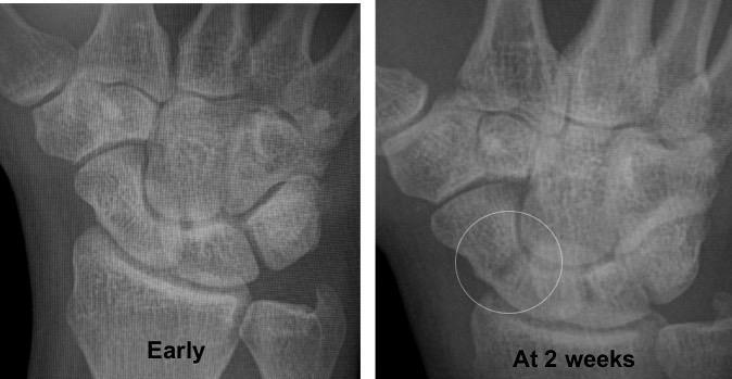 Scaphoid fractures X-rays Acute Delayed CT Scan MRI