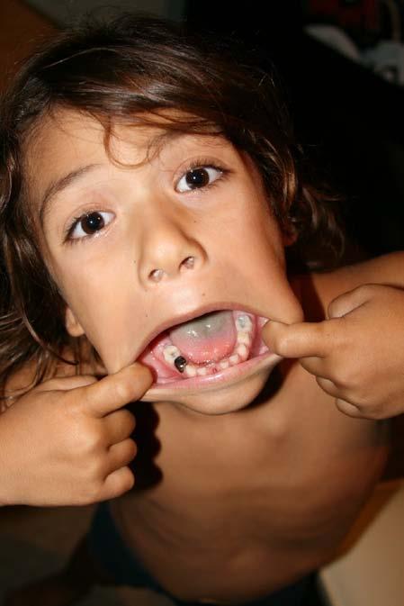 THINKING BEYOND PRIMARY TEETH Primary teeth Last 5-10 years Permanent teeth May last