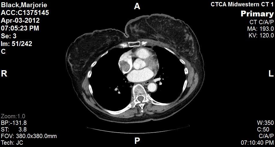 Fig 2 PET scan shows a hyper-metabolic focus in right atrium Following the PET scan, A CT scan of the chest, abdomen and pelvis on 04/03/12 confirmed the presence of a 3 x 2.