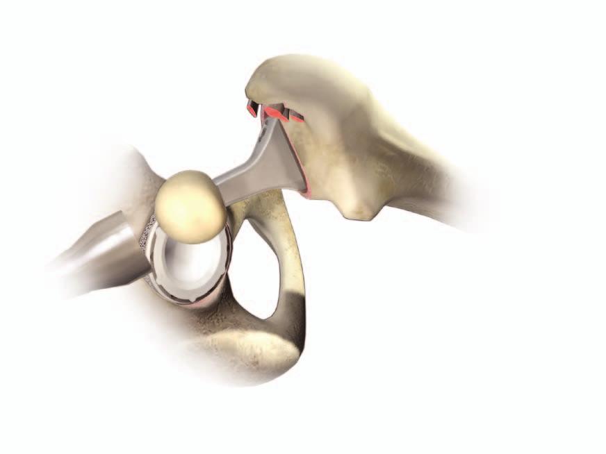 FEMORAL HEAD IMPACTION & CLOSURE Femoral head impaction The appropriate femoral head is placed onto the taper and lightly tapped home using the head impactor (Figure 33).