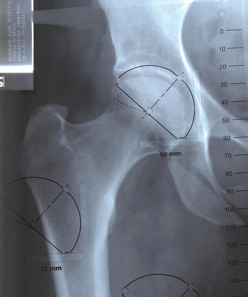 ACETABULAR AND FEMORAL TEMPLATING Take into consideration any anatomical anomoly, dysplasia, previous fracture or leg length discrepancy.