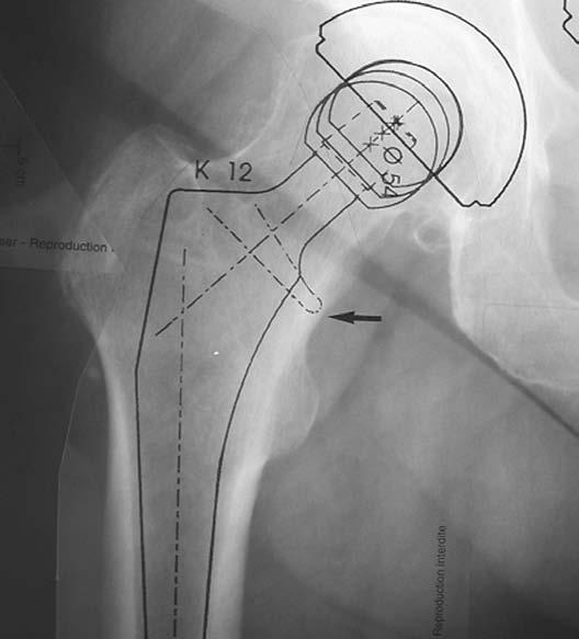 The acetabular component should be placed on structurally sound bone to optimise the opportunity for bone ingrowth.