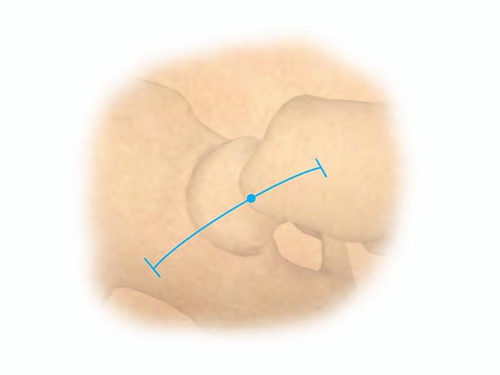 EXPOSURE An initial skin incision is made over the tip of the greater trochanter. The incision is extended approximately 2.