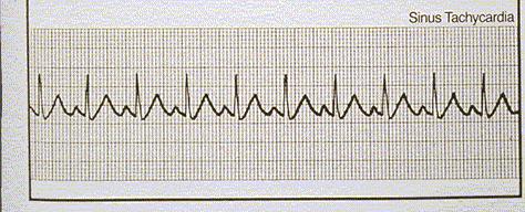 V=A Sinus Tach The V = A branch is where sinus tachycardia or 1:1 SVTs will be classified VT that has 1:1