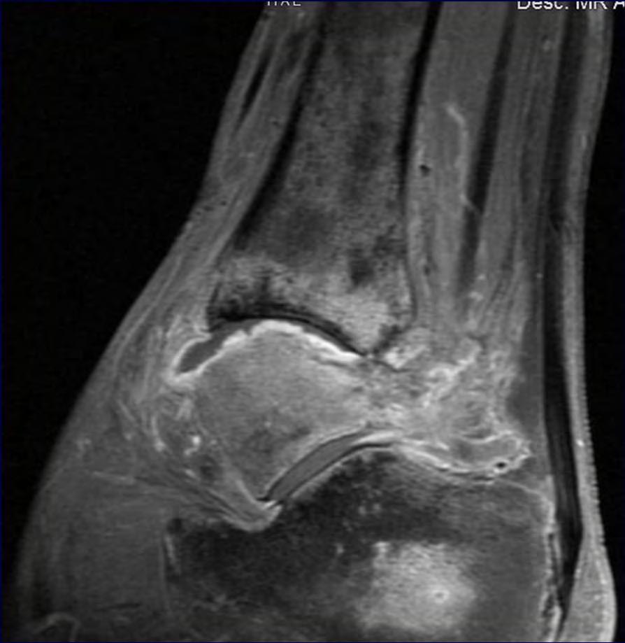 MRI Characterizes both bone and soft-tissue infection Quite sensitive but often not specific, and tends to overcall the