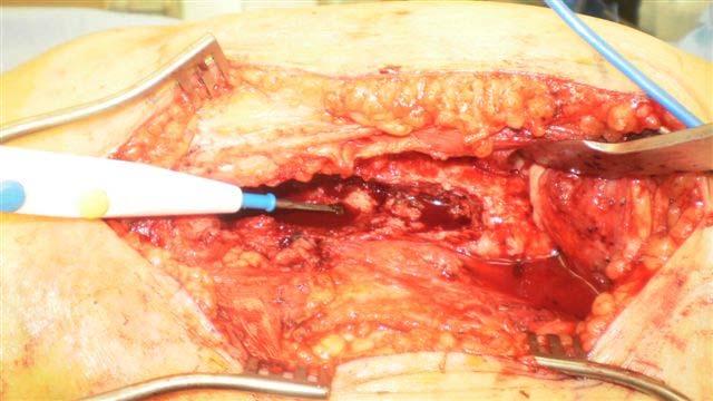 Saucerization of the femur,