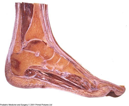 Ankle arthrodesis - Indications Arthritis Primitive Post-traumatic Rheumatoid Post-infection